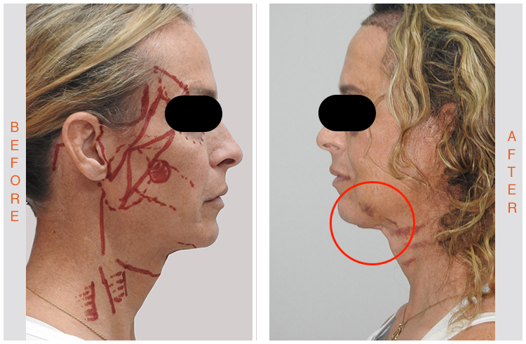 Esthetic Lyft Treatment